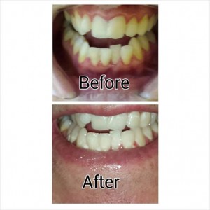 liam harris teeth
